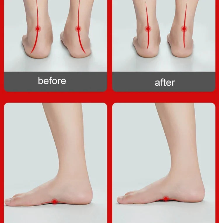 Flat Foot Orthopedic Insole Arch Collapse Support Pad Adult And Child Foot Valgus Orthosis, L (White)