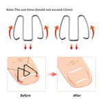 6pcs /Box Ortho Wire Nail Insertion Orthotic Toe Nail Ortho Hooks
